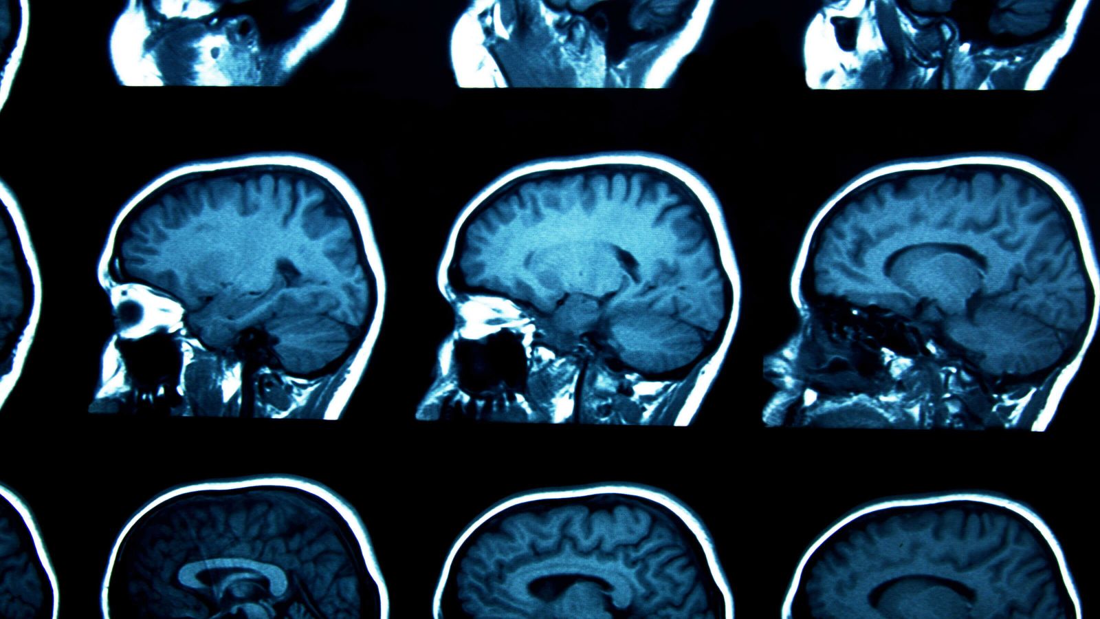 An MRI scan of a human head showing a repeated x-ray image of a blue head against a black background.