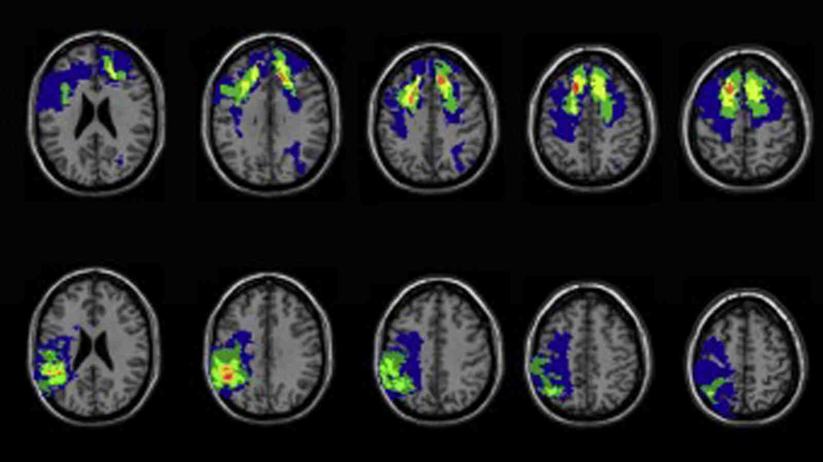 The researchers examined damage to different parts of the brain. 