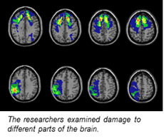 CT brain scans with damage to different parts of the brain