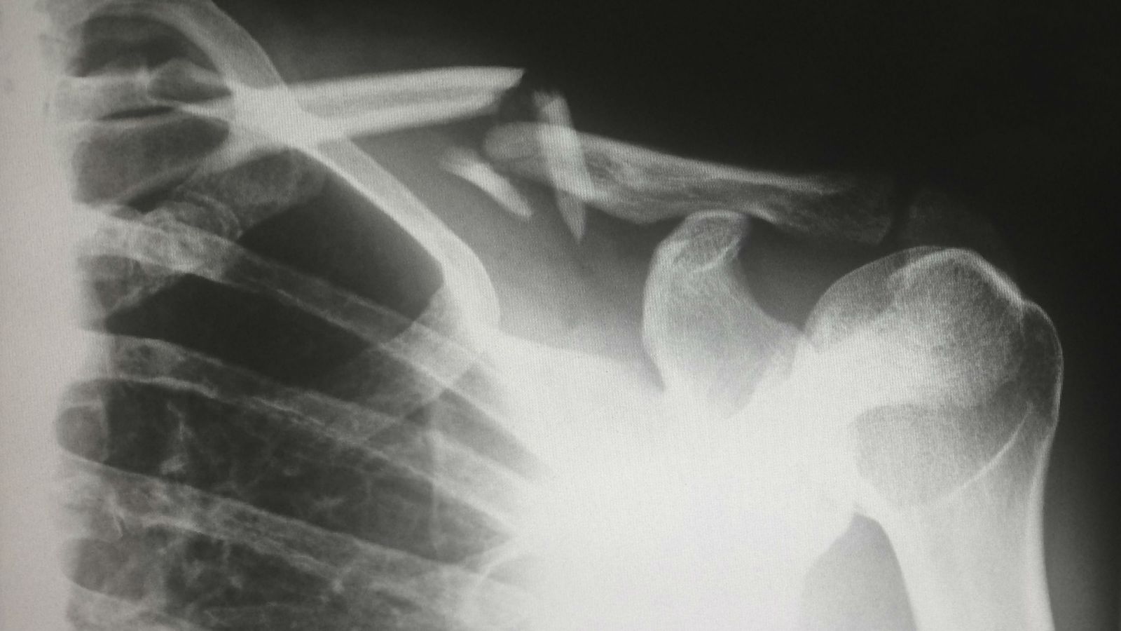 X-ray of broken shoulder bone.