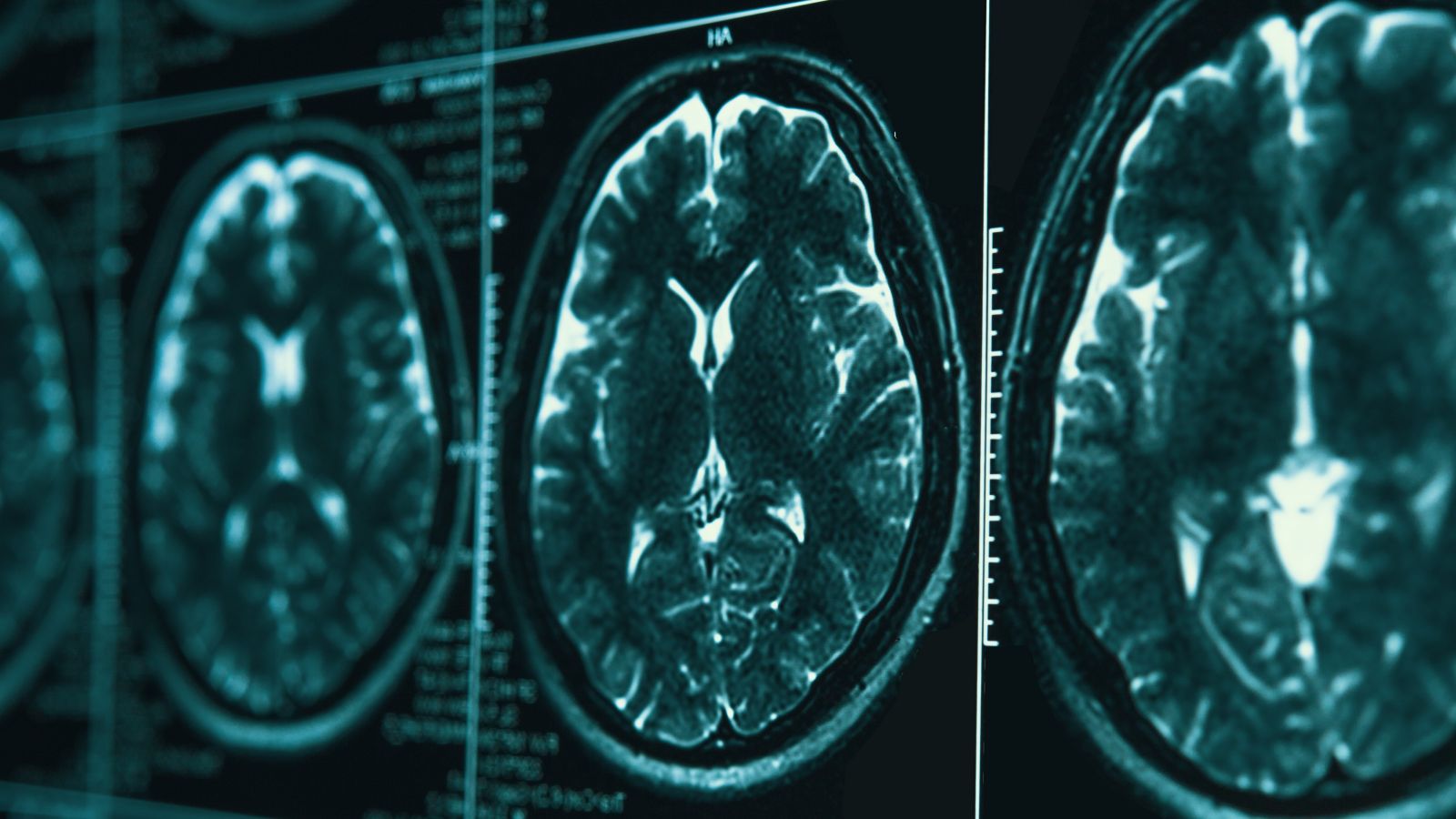 A series of MRI scans of a brain.