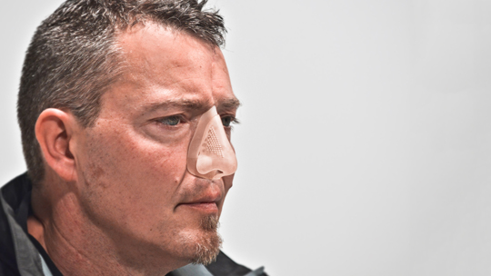 3D printed prosthetic nose