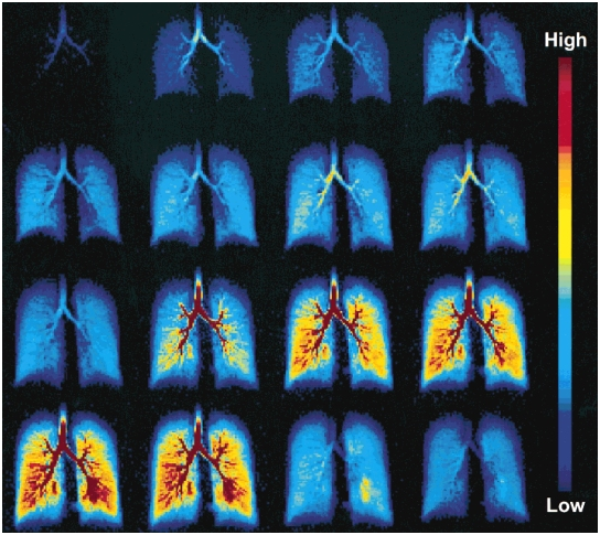 MRI of lungs inhaling and exhaling